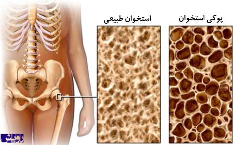 پوکی استخوان - mahu.ir