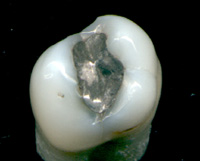 امالگام دندان