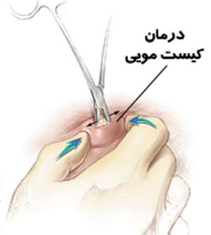 کیست مویی در قسمت تحتانی کمر 1