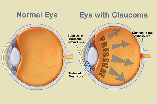 Eyes Glaucoma