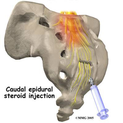 منطقه بیهوشی کودال cauadal anesthesia
