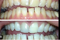 سفید شدن دندان با تکنیک کتاب یوگا ی صورت